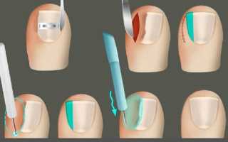 Эффективные способы удаления ногтя на пальце ноги