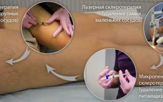 Удаление сосудистых звездочек на ногах: какой способ выбрать