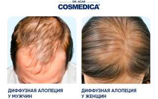 Лечение выпадения волос – длительный процесс