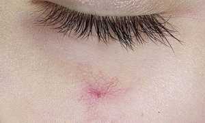 Как выполняется удаление сосудистых звездочек на лице лазером