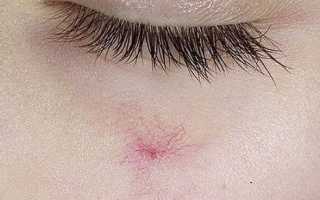 Как выполняется удаление сосудистых звездочек на лице лазером