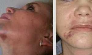 Что нельзя делать после биоревитализации, советы по правильному уходу