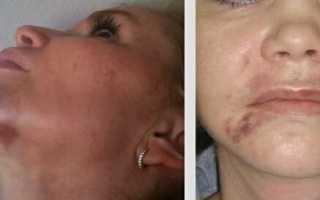 Что нельзя делать после биоревитализации, советы по правильному уходу