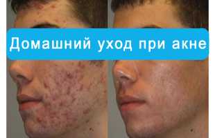 Как избавиться от прыщей: боремся с угревой сыпью