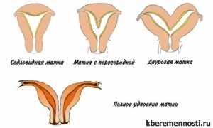 Седловидная матка и беременность