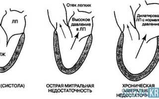 Регургитация на клапане легочной артерии 1 степени