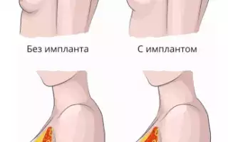 Грудные имплантаты — все опасности силикона