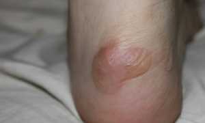 Как быстро и эффективно вылечить мозоль на пятке в домашних условиях