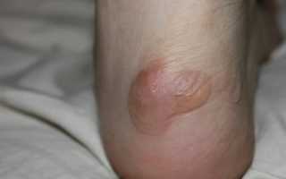 Как быстро и эффективно вылечить мозоль на пятке в домашних условиях