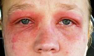 Опухшие, шелушащиеся и красные веки: причины и методы лечения