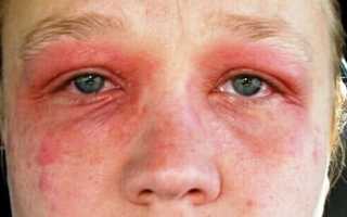 Опухшие, шелушащиеся и красные веки: причины и методы лечения