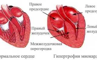 Атрофия левого желудочка сердца что это такое