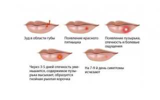Чем лечить герпес на губе: не пропустите момент