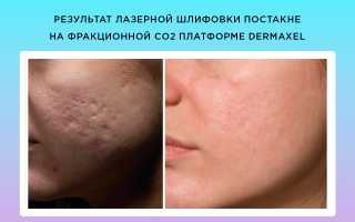 Шлифовка лица — наиболее эффективные методики