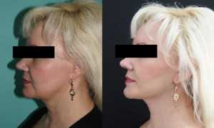 Ультразвуковой SMAS-лифтинг лица: показания и результаты процедуры