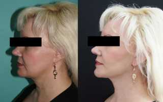 Ультразвуковой SMAS-лифтинг лица: показания и результаты процедуры