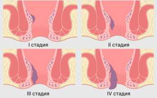 Геморрой при беременности: неизбежное зло?