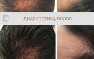 Лечение волос и кожи головы – начинать нужно с обследования