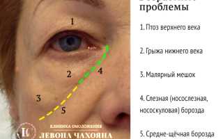 Мешки под глазами: неприятность эту нужно побороть!
