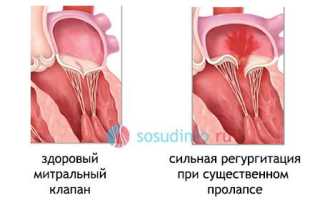 Пролапс клапана