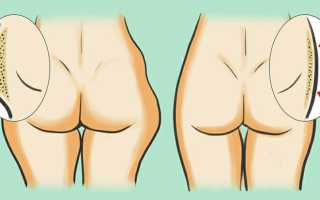 Как быстро убрать ушки на бедрах в домашних условиях: комплекс упражнений