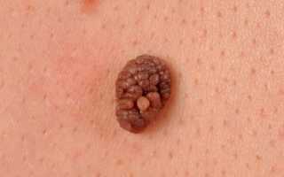 Папилломы на теле: причины появления и способы лечения