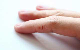 Трескается кожа на пальцах рук: причины и лечение