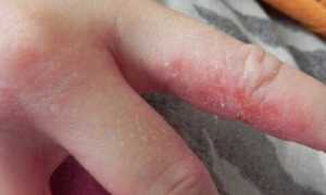 Причины раздражения между пальцами рук и лечение