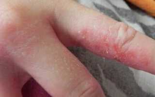 Причины раздражения между пальцами рук и лечение