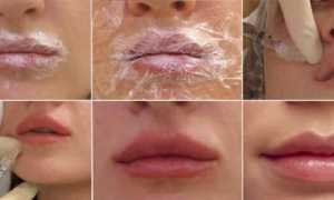 Увеличение губ гиалуроновой кислотой: техника, эффект и последствия процедуры