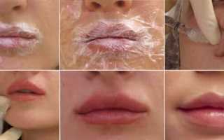 Увеличение губ гиалуроновой кислотой: техника, эффект и последствия процедуры