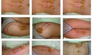 Баночный массаж от целлюлита: техника выполнения