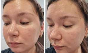 Как правильно применять дегтярное мыло для кожи лица?