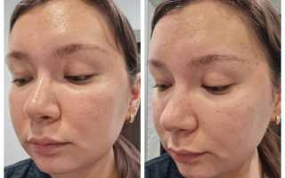 Как правильно применять дегтярное мыло для кожи лица?