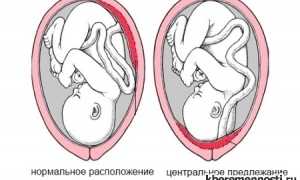 Центральное предлежание плаценты