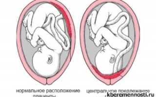 Центральное предлежание плаценты