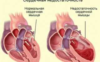 Сердечная недостаточность