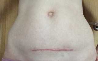 Шрам после кесарева сечения: виды, сроки заживления и методы устранения