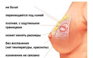 Удаление фиброаденомы молочной железы: все о проблеме