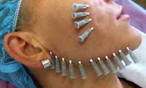 Нитевой лифтинг — преимущества и недостатки, какие нити выбрать, как долго держится эффект?