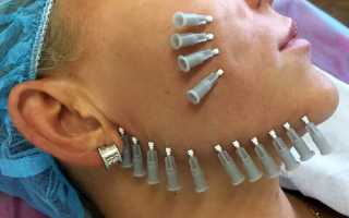 Нитевой лифтинг — преимущества и недостатки, какие нити выбрать, как долго держится эффект?