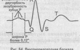 Нарушение внутрипредсердной проводимости что это такое
