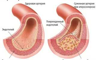 Лечение атеросклероза сосудов нижних конечностей лекарства