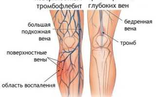 Лечение при тромбофлебите нижних конечностей