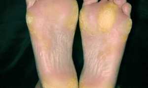 Причины сухой кожи на ногах и методы лечения
