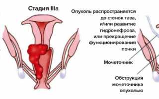 Рак матки — классическая триада симптомов