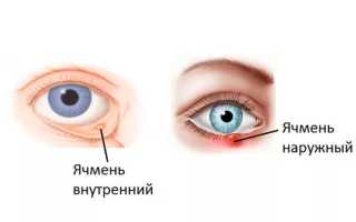 Как лечить ячмень на веке глаза – несложные методы