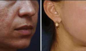 Плазмолифтинг лица: безоперационная омолаживающая пластика