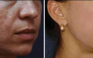 Плазмолифтинг лица: безоперационная омолаживающая пластика