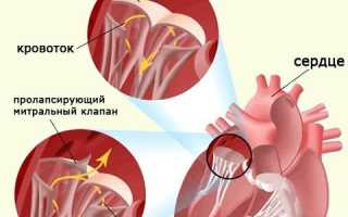 Чем опасен пролапс митрального клапана 1 степени
